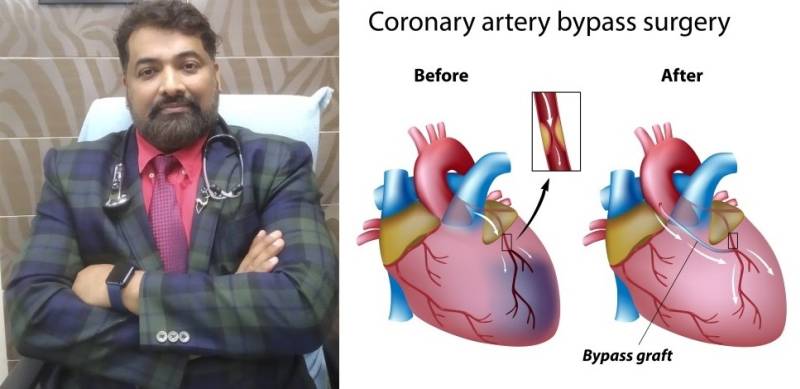 bypass-surgery-dr-pranav-kabra-heart-disease