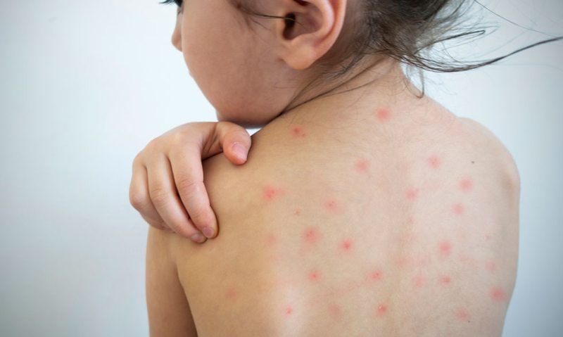 measles-outbreak-mumbai