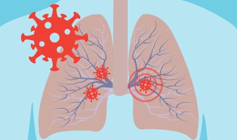 covid-lung-damage